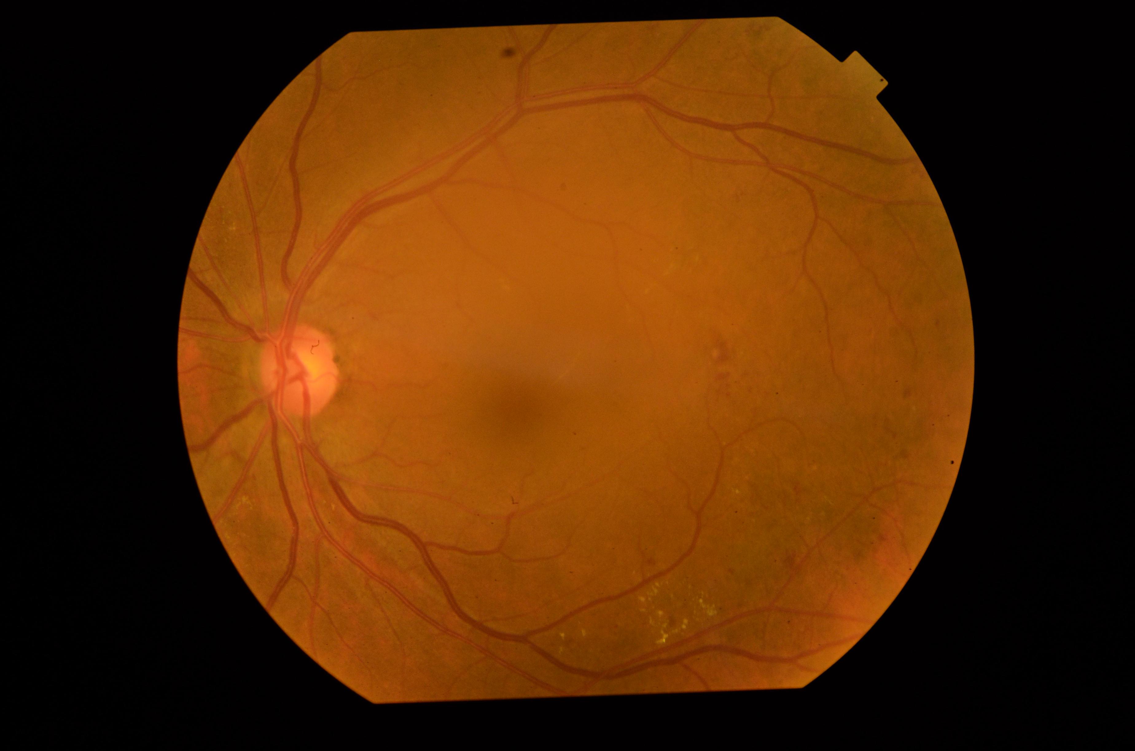 DIABETIC RETINOPATHY- FUNDUS IMAGE DATASET(AGAR300) | IEEE DataPort